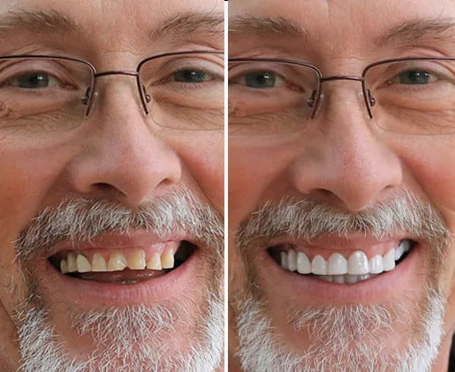 Velixxo™ Snap-On Veneers