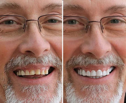 Velixxo™ Snap-On Veneers